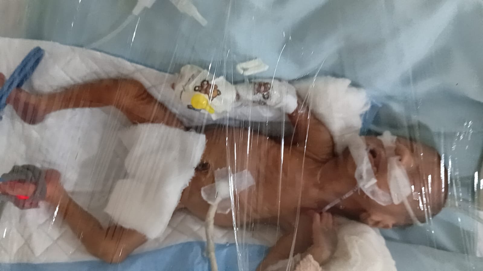 A Heart That Needs Help to Keep Beating Baby of Amulya